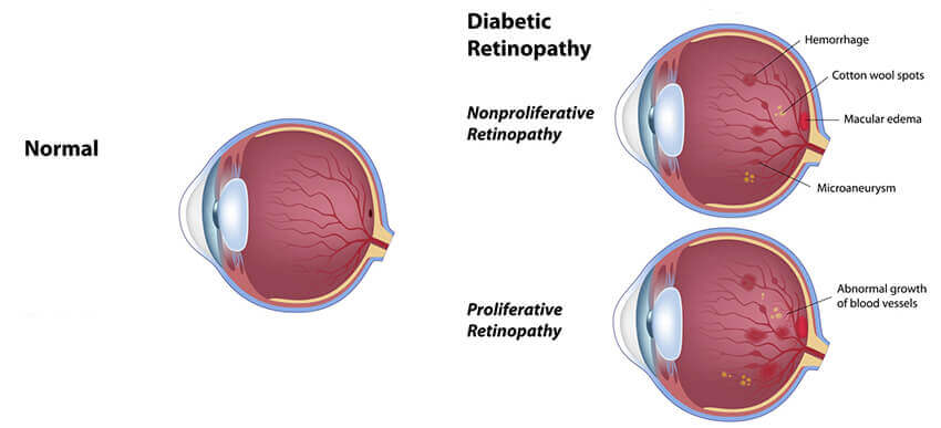 A Chart Showing a Healthy Eye Compared to One with Diabetic Retinopathy