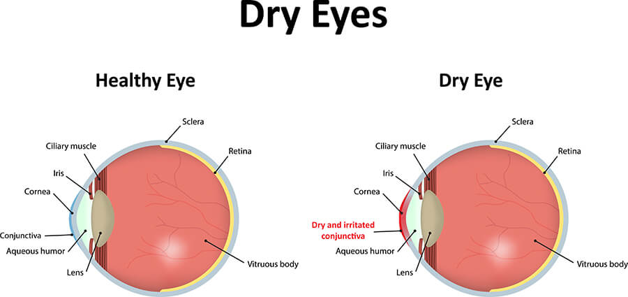 Chart Showing a Healthy Eye Compared to One With Dry Eye