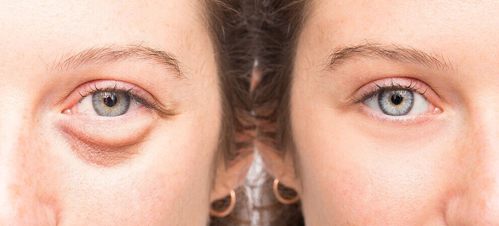 Blepharoplasty Before & After