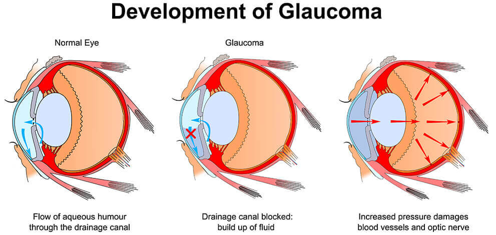 Development of Glaucoma