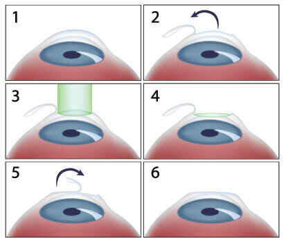 Lasik procedure diagram