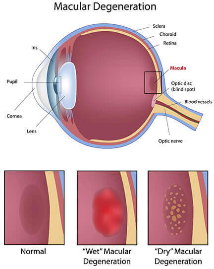 Diagram of Macular Degeneration