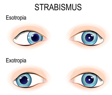 Strabismus Diagram